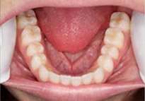 open mouth picture of lower teeth